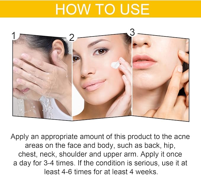EELHOE Cystic Acne Treatment Cream – Anti-Acne, Hydrating Formula for Clear & Smooth Skin (30ml)