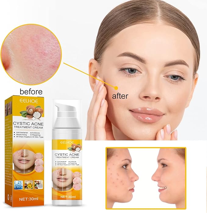 EELHOE Cystic Acne Treatment Cream – Anti-Acne, Hydrating Formula for Clear & Smooth Skin (30ml)