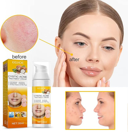 EELHOE Cystic Acne Treatment Cream – Anti-Acne, Hydrating Formula for Clear & Smooth Skin (30ml)