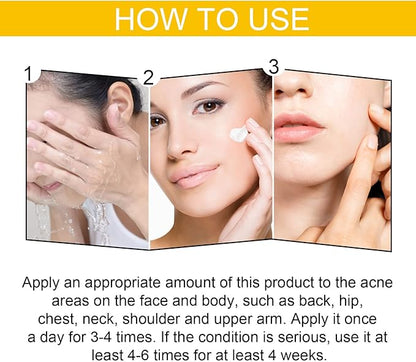 EELHOE Cystic Acne Treatment Cream – Anti-Acne, Hydrating Formula for Clear & Smooth Skin (30ml)