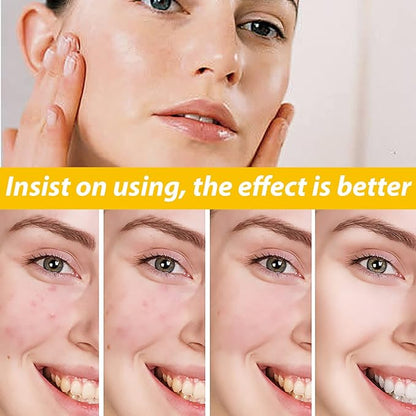 EELHOE Cystic Acne Treatment Cream – Anti-Acne, Hydrating Formula for Clear & Smooth Skin (30ml)