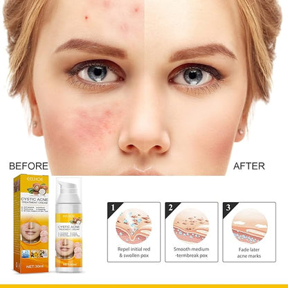 EELHOE Cystic Acne Treatment Cream – Anti-Acne, Hydrating Formula for Clear & Smooth Skin (30ml)